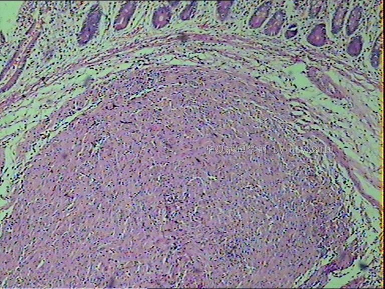 空回肠肿物，像麦考尔憩室发生的，异位组织还是间叶来源的呢？？？图2