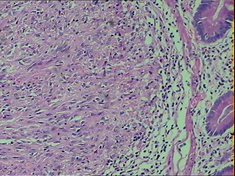 空回肠肿物，像麦考尔憩室发生的，异位组织还是间叶来源的呢？？？图4
