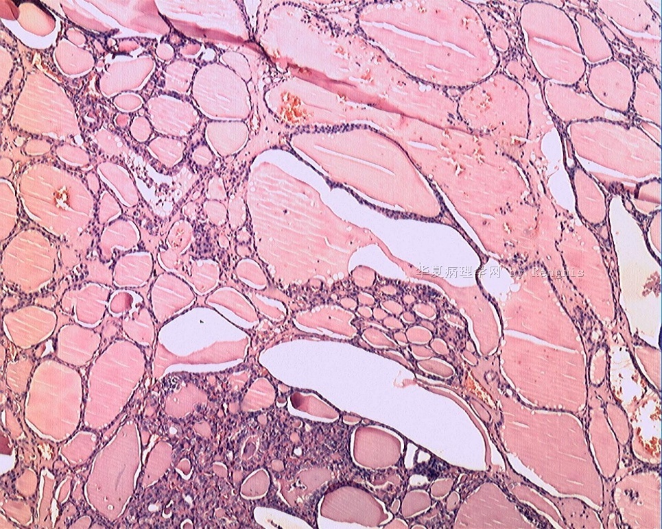 甲状腺峡部肿物图5