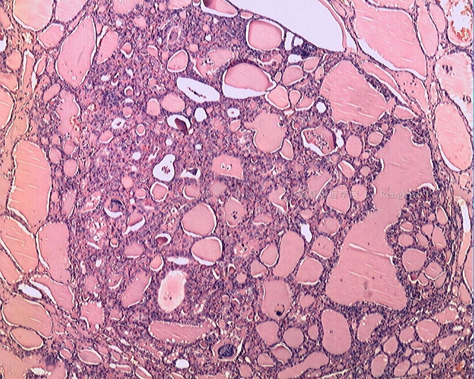 甲状腺峡部肿物图6