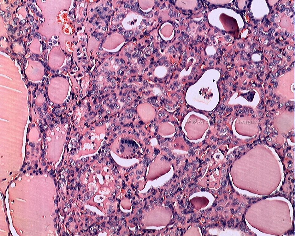 甲状腺峡部肿物图13