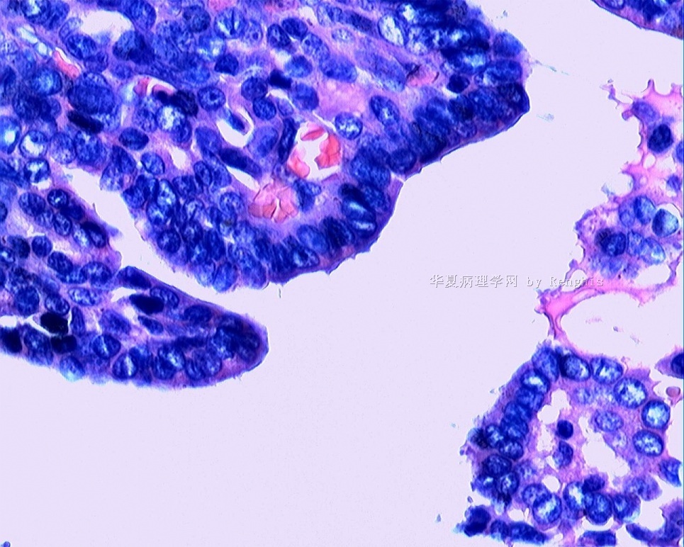 甲状腺峡部肿物图20