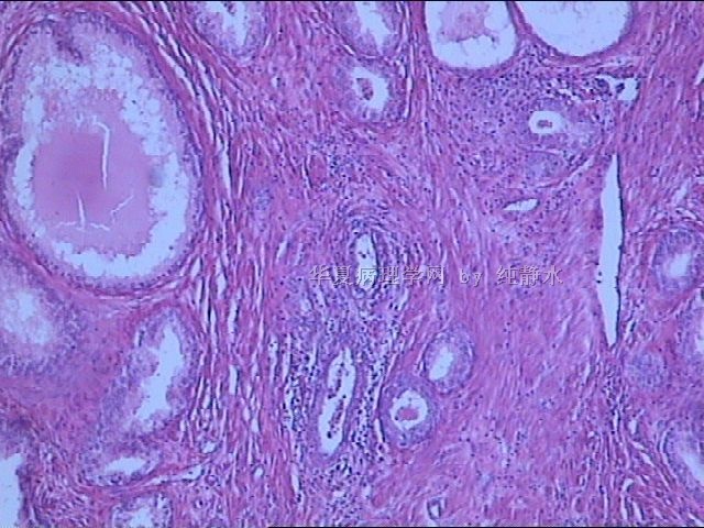 前列腺增生？病理新人，请教其中小腺体有无问题。图1