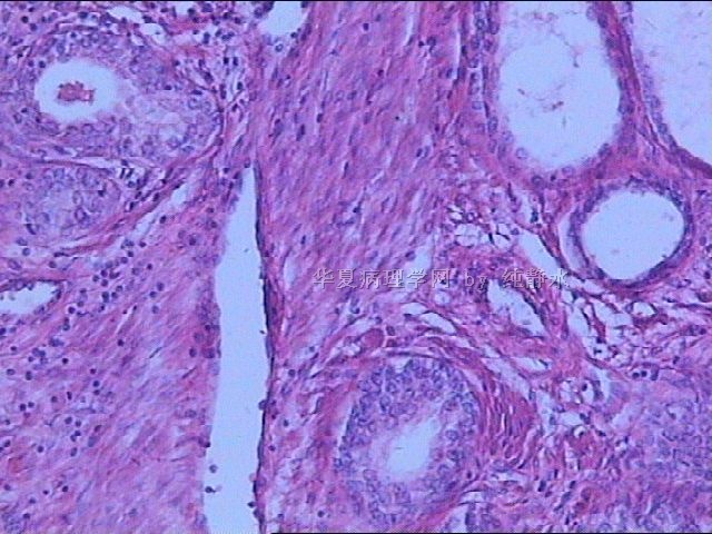 前列腺增生？病理新人，请教其中小腺体有无问题。图2
