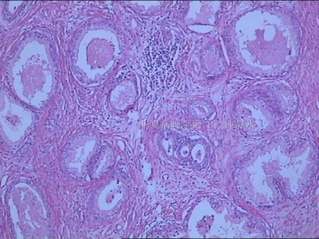 前列腺增生？病理新人，请教其中小腺体有无问题。图3