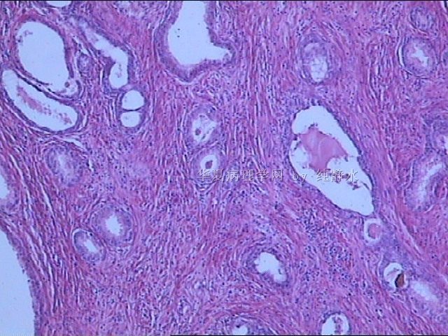 前列腺增生？病理新人，请教其中小腺体有无问题。图4