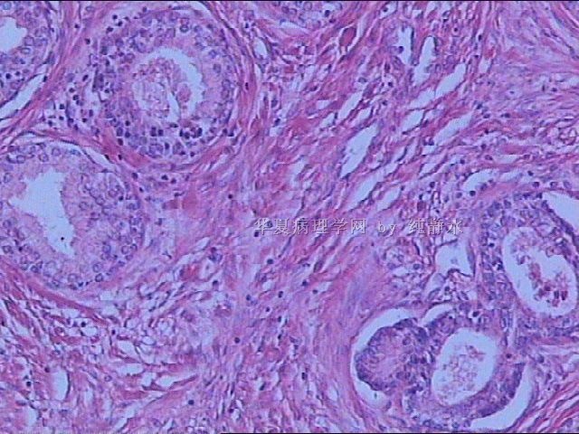 前列腺增生？病理新人，请教其中小腺体有无问题。图5