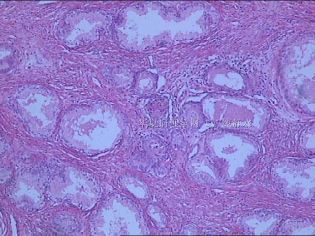 前列腺增生？病理新人，请教其中小腺体有无问题。图6