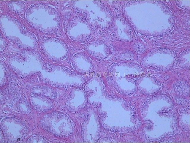 前列腺增生？病理新人，请教其中小腺体有无问题。图8