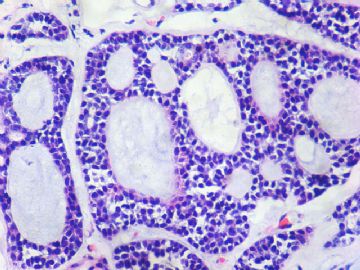 腮腺肿瘤（P110991）图14
