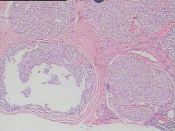甲状腺肿块图4
