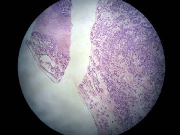 卵巢囊性肿瘤图1