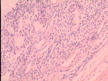 22岁，右侧卵巢囊肿(关键是第四张图到第十一张图的细胞)图9