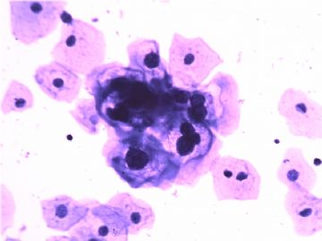 TCT是ASC-US或LSIL?图3