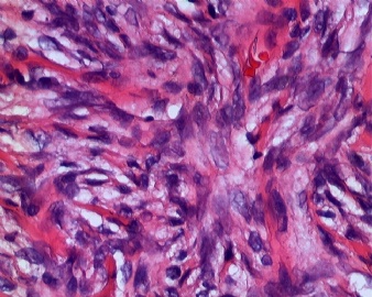 右腹壁肿物图23