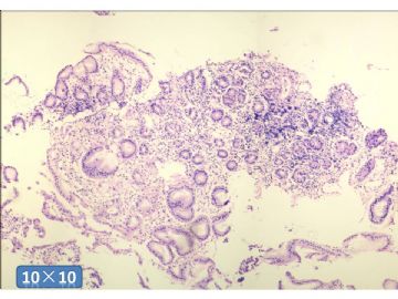 一例胃镜活检，是癌么？图11