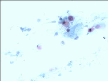 宫颈光滑一例--84岁体检,传统涂片图8