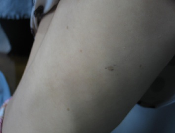 前臂色素斑1月累积背部图3