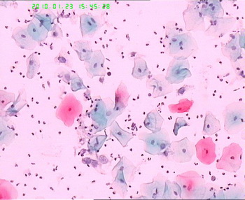 宫颈TCT检查图1