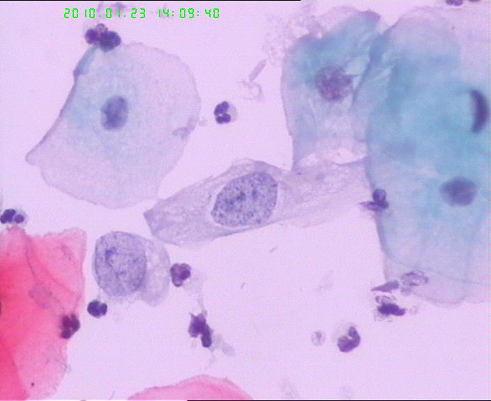 宫颈TCT检查图3
