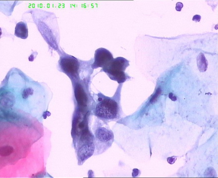宫颈TCT检查图5