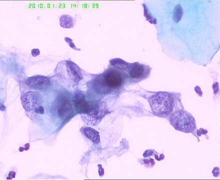 宫颈TCT检查图6
