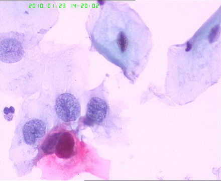宫颈TCT检查图7