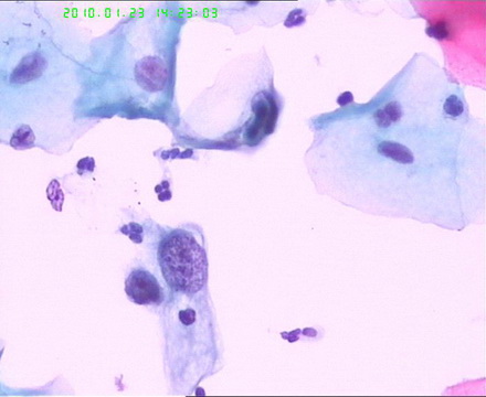 宫颈TCT检查图9