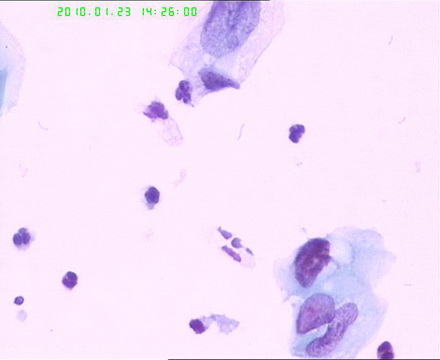 宫颈TCT检查图11