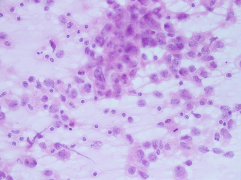 男性，30岁，左腹股沟淋巴结穿刺图1