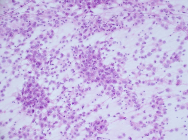 男性，30岁，左腹股沟淋巴结穿刺图2