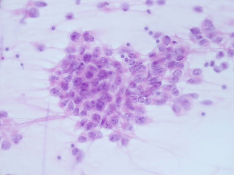 男性，30岁，左腹股沟淋巴结穿刺图3