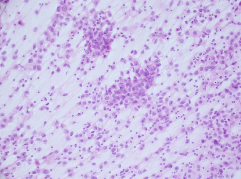 男性，30岁，左腹股沟淋巴结穿刺图4