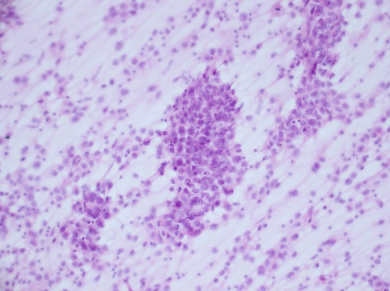 男性，30岁，左腹股沟淋巴结穿刺图5