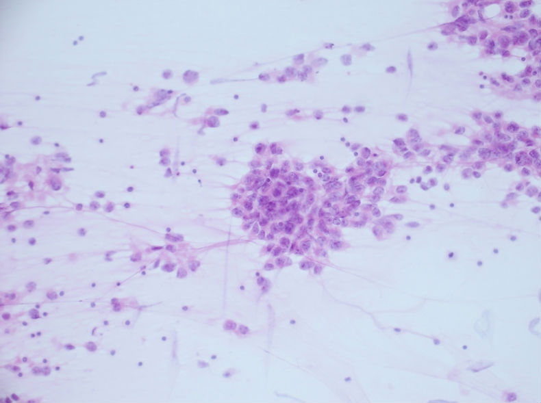 男性，30岁，左腹股沟淋巴结穿刺图6