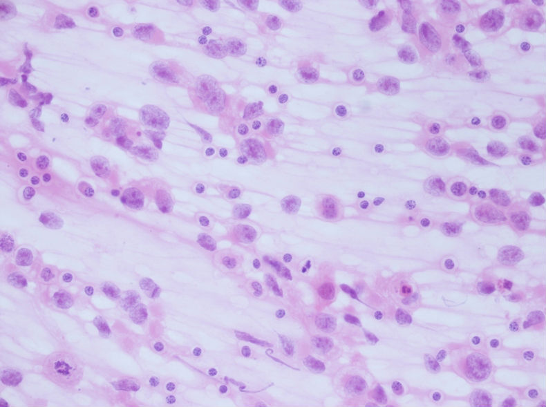 男性，30岁，左腹股沟淋巴结穿刺图7