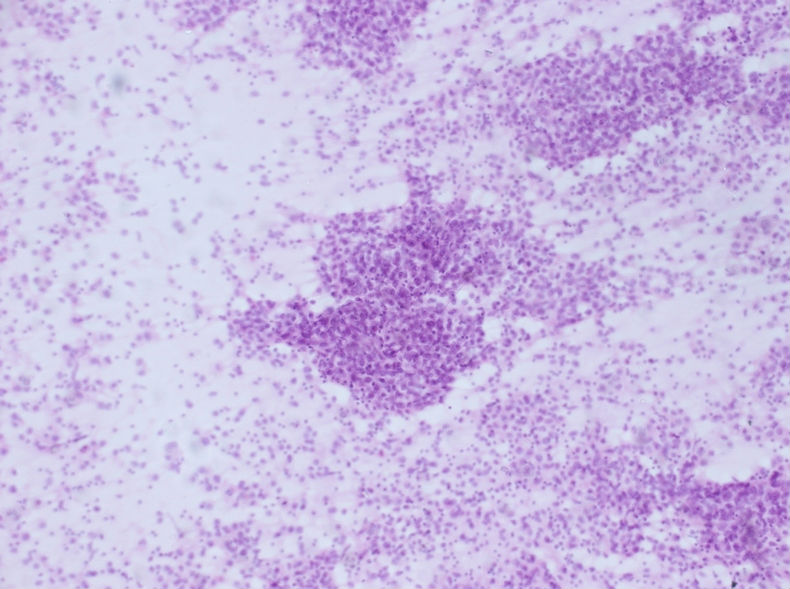 男性，30岁，左腹股沟淋巴结穿刺图8