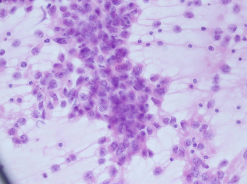 男性，30岁，左腹股沟淋巴结穿刺图9