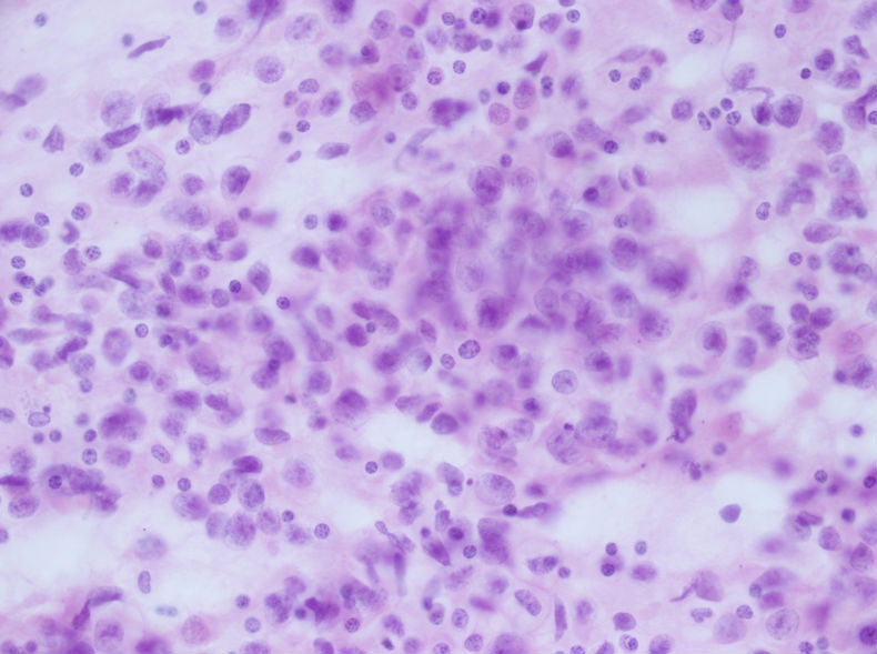 男性，30岁，左腹股沟淋巴结穿刺图11