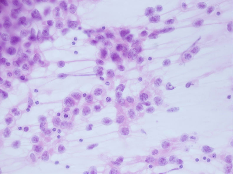 男性，30岁，左腹股沟淋巴结穿刺图12