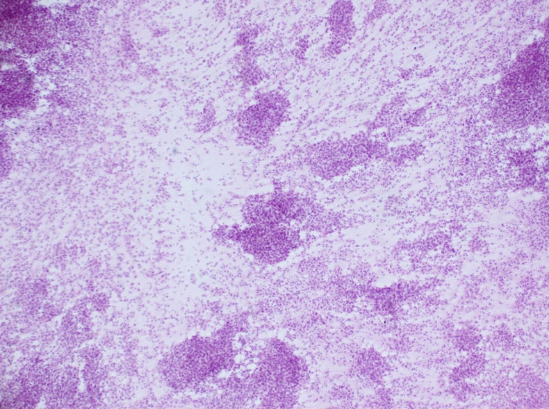 男性，30岁，左腹股沟淋巴结穿刺图13