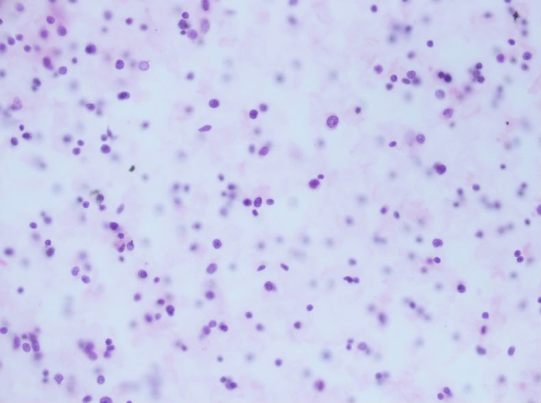 病例分享——男性，55岁，左胸壁肋间肿块图1