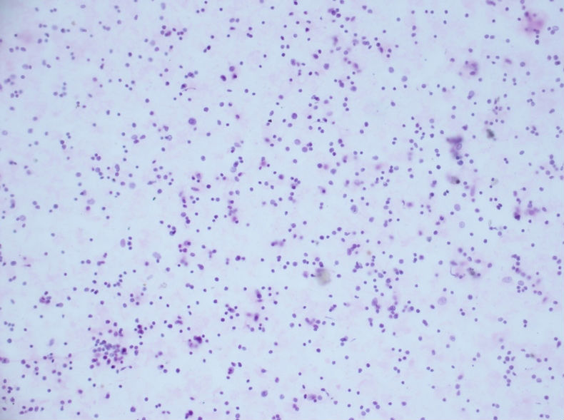 病例分享——男性，55岁，左胸壁肋间肿块图7