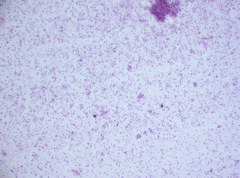 病例分享——男性，55岁，左胸壁肋间肿块图8