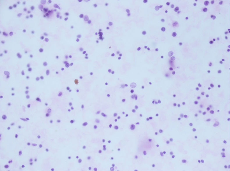 病例分享——男性，55岁，左胸壁肋间肿块图9