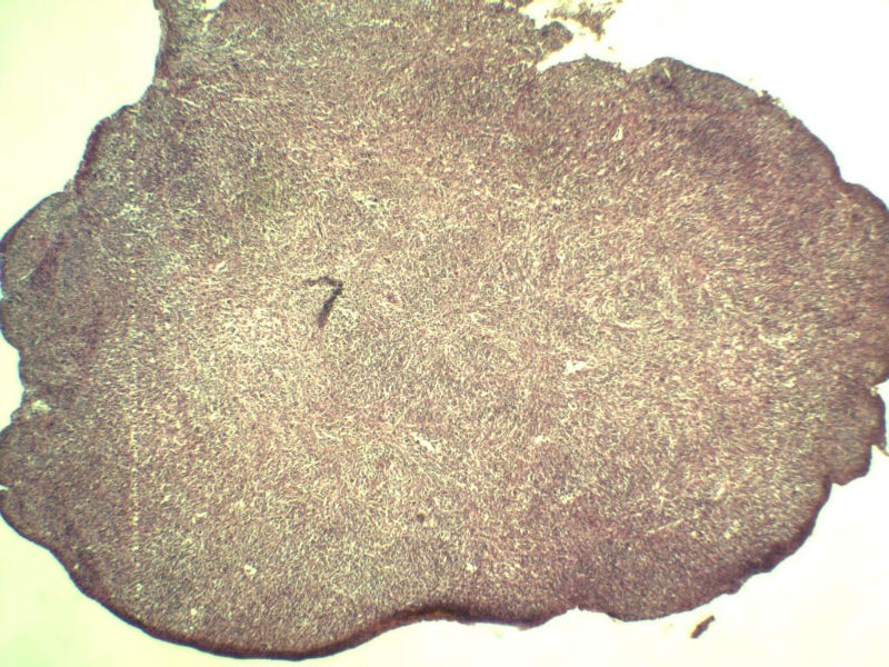 腹股沟 多枚淋巴结活检图1