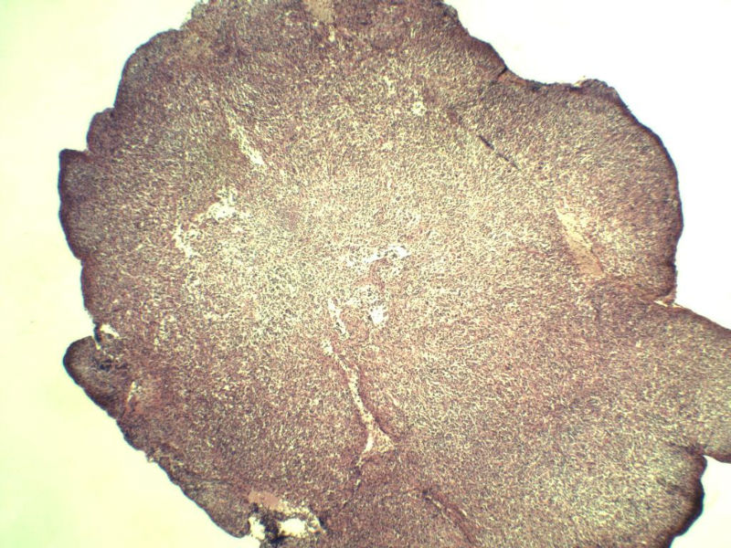 腹股沟 多枚淋巴结活检图2