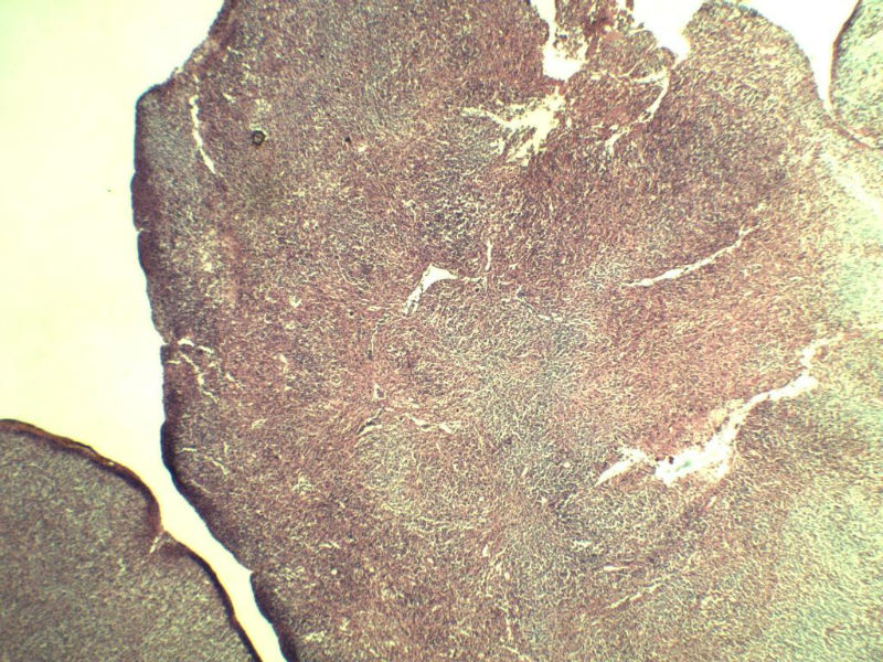 腹股沟 多枚淋巴结活检图3