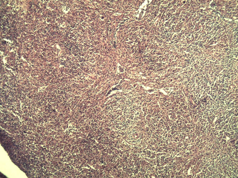 腹股沟 多枚淋巴结活检图4