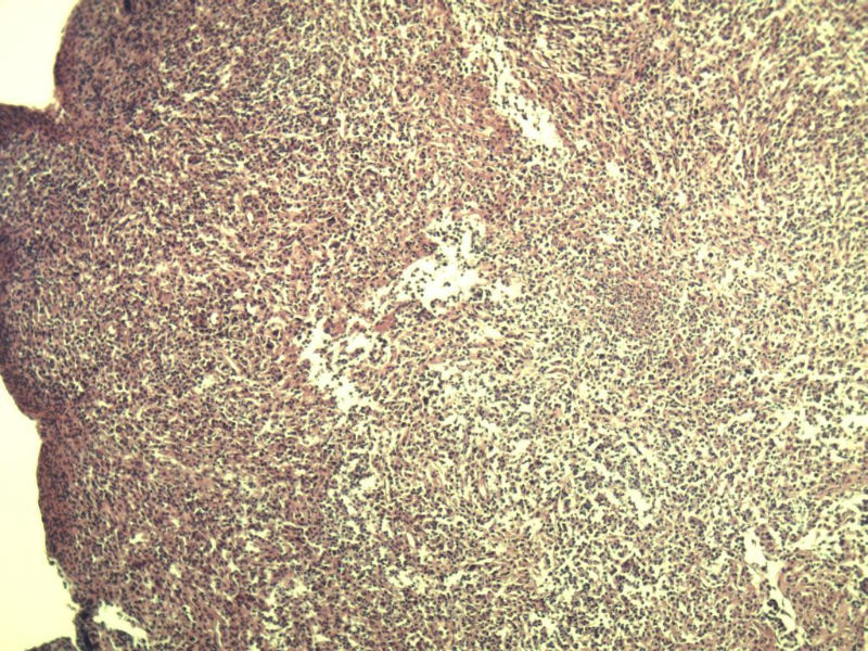 腹股沟 多枚淋巴结活检图5